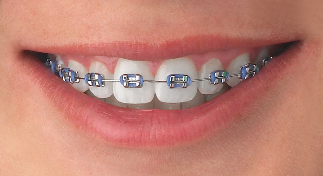 Dentista: Coronas metal porcelana www.dentistamonterrey.mx 